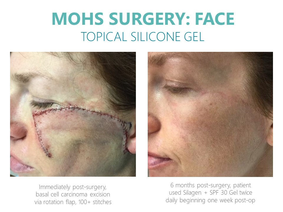 Silagen Scar Refinement