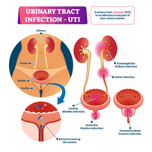 Understanding UTI and Bacteriuria: A Guide on When to Seek Help