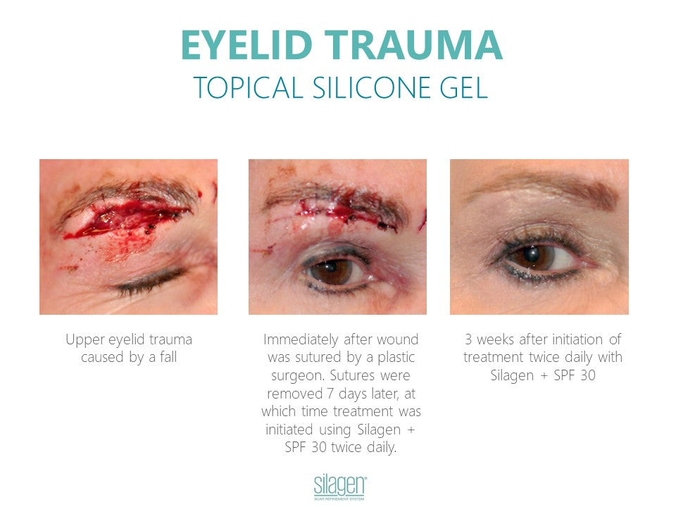 Silagen Scar Refinement 15 gm