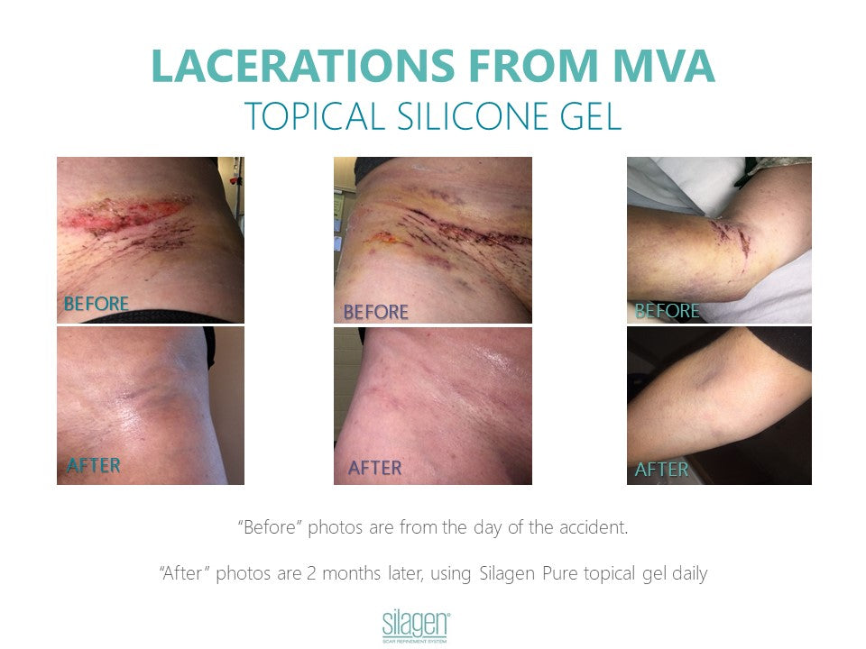 Silagen Scar Refinement 15 gm