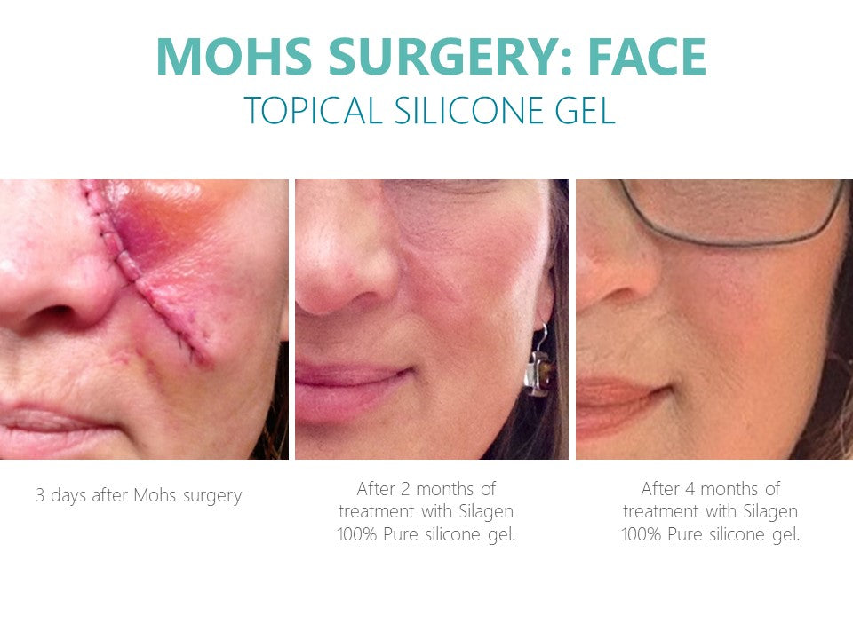 Silagen Scar Refinement 15 gm